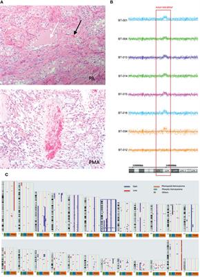A molecular study of pediatric pilomyxoid and pilocytic astrocytomas: Genome-wide copy number screening, retrospective analysis of clinicopathological features and long-term clinical outcome